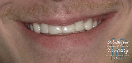 Close up of flawless smile after Bioclear dental bonding