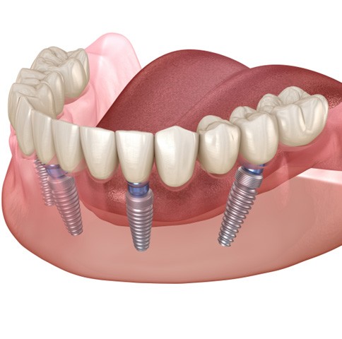 Illustration of All-on-4 in Weatherford, TX for lower arch