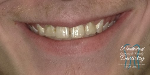 Close up of imperfect teeth before Bioclear dental bonding