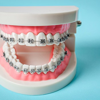 A closeup of a tooth model with metal braces