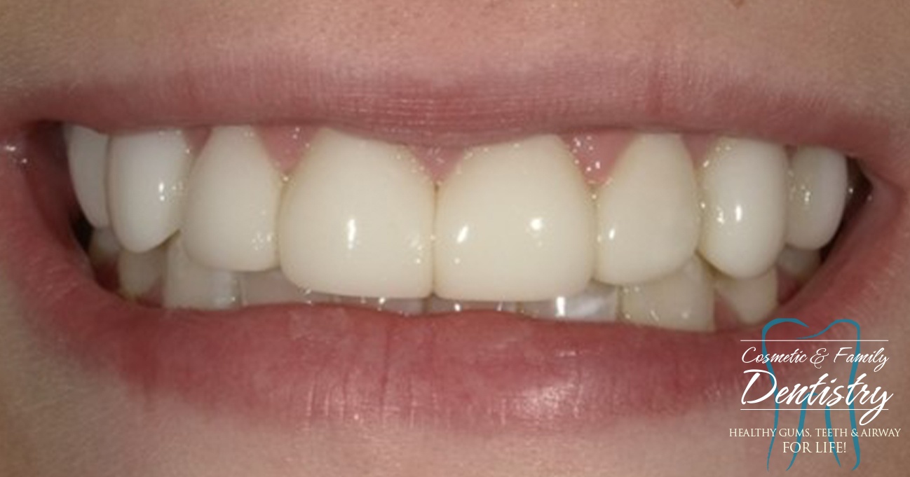 Close up of flawless smile after Bioclear dental bonding