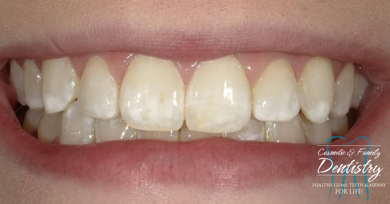 Close up of imperfect teeth before Bioclear dental bonding