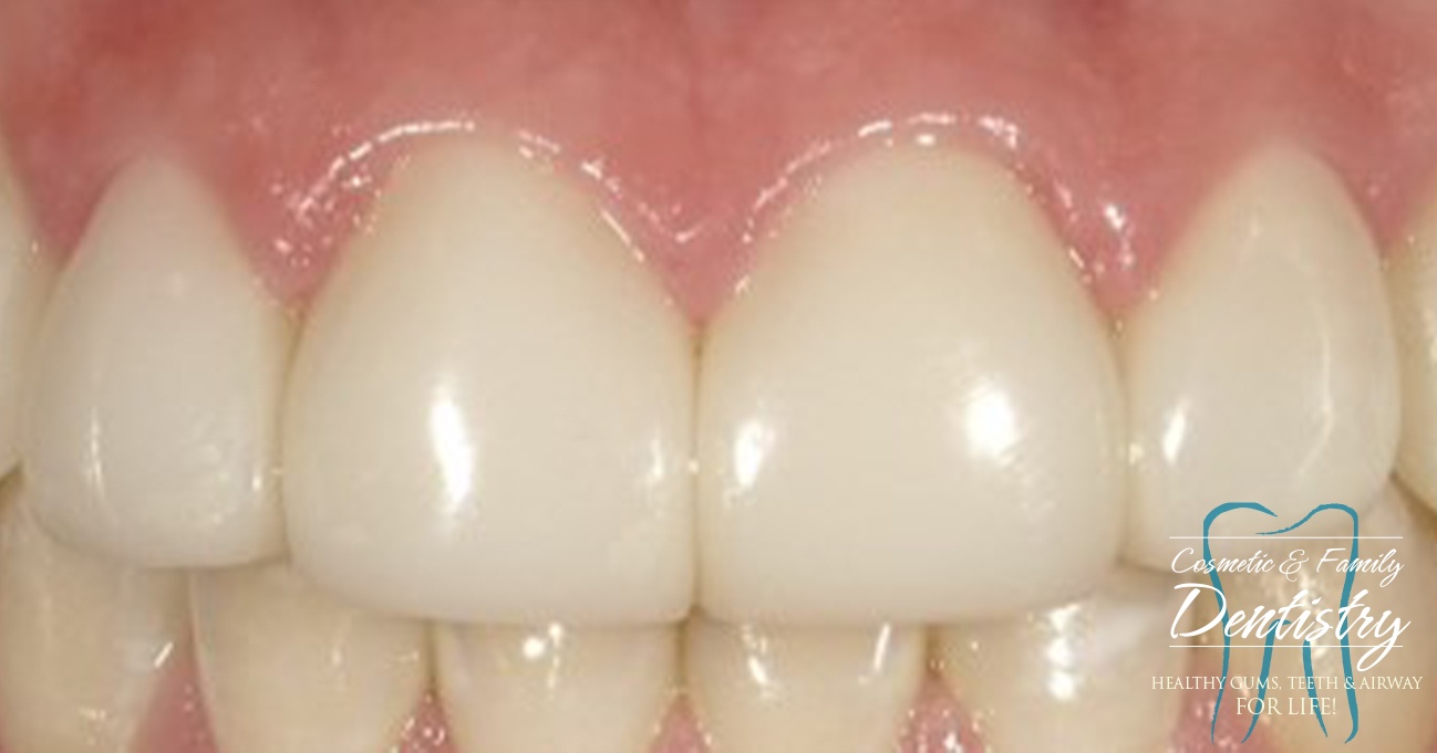 Close up of flawless smile after Bioclear dental bonding