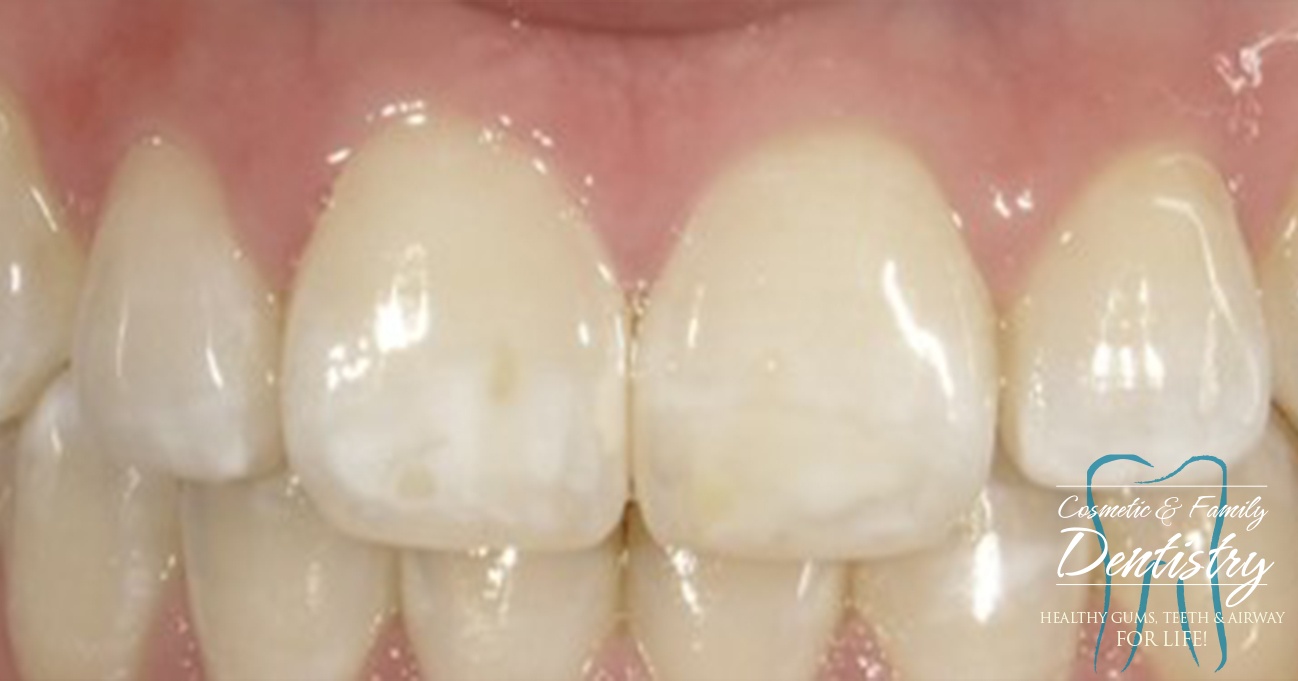 Close up of imperfect teeth before Bioclear dental bonding