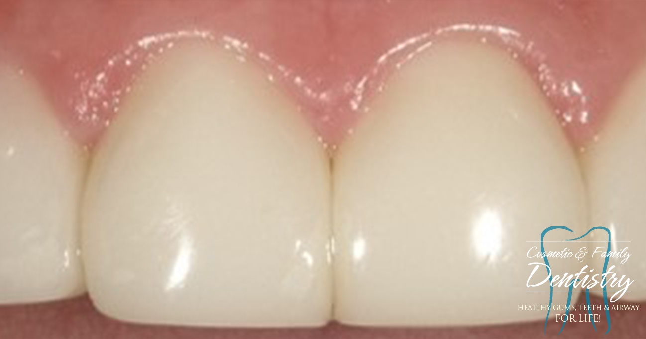 Close up of flawless smile after Bioclear dental bonding