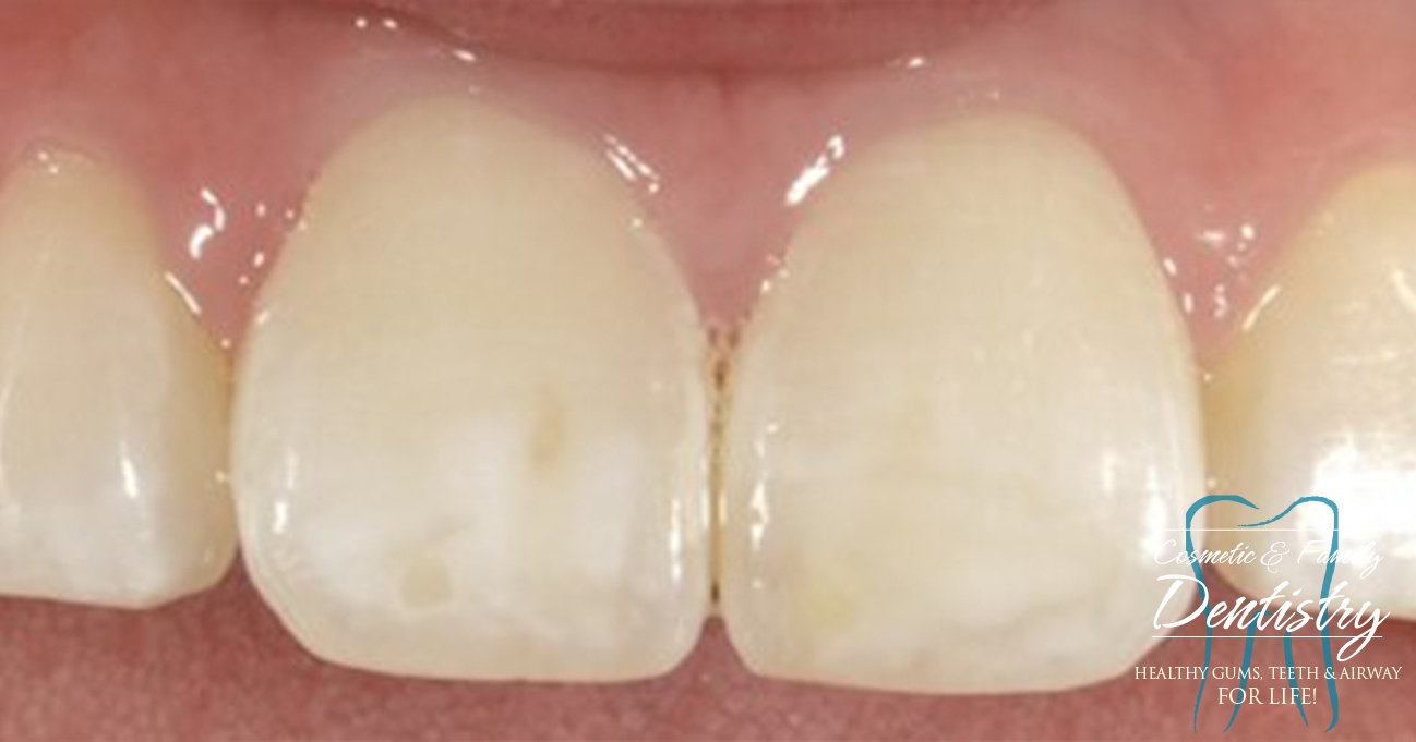 Close up of imperfect teeth before Bioclear dental bonding