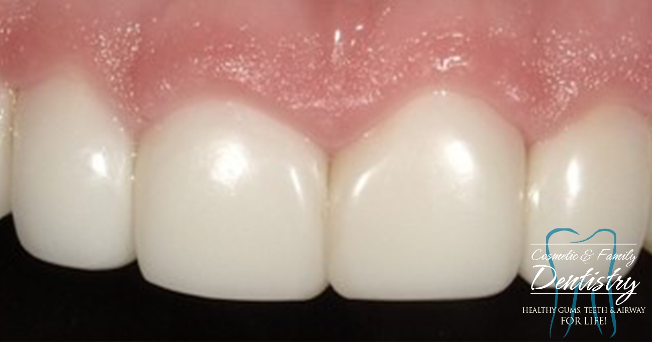 Close up of flawless smile after Bioclear dental bonding