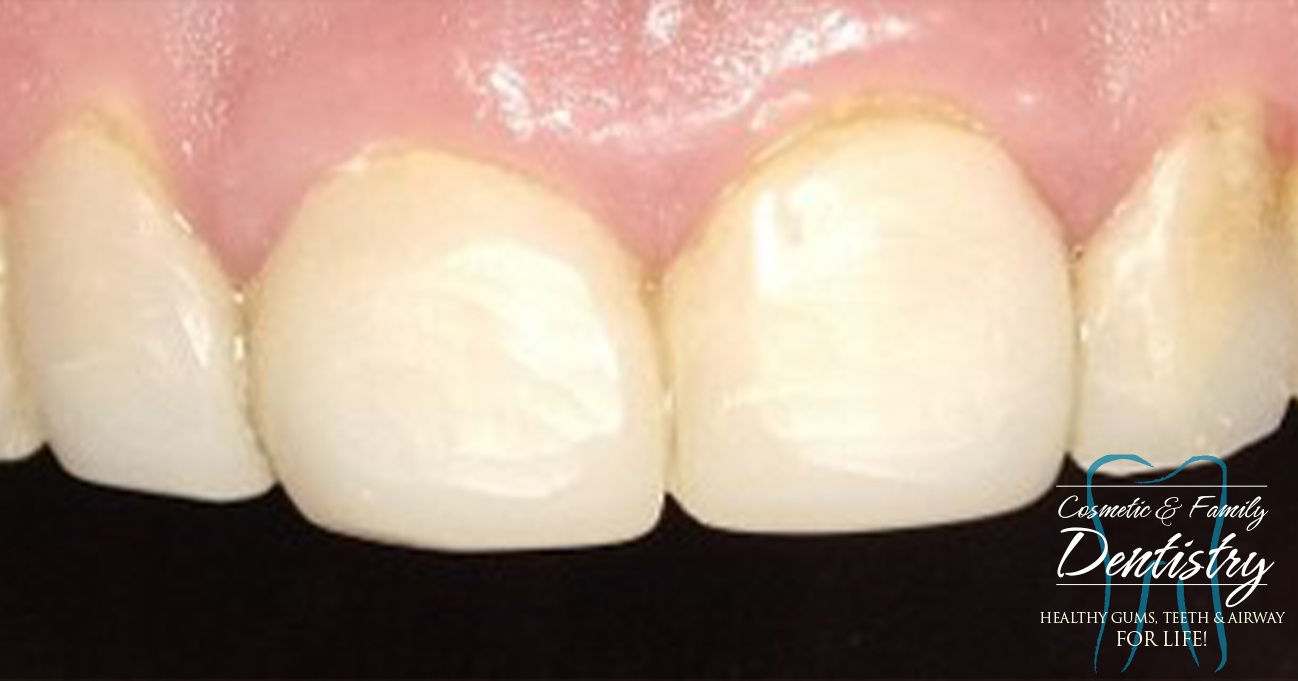 Close up of imperfect teeth before Bioclear dental bonding