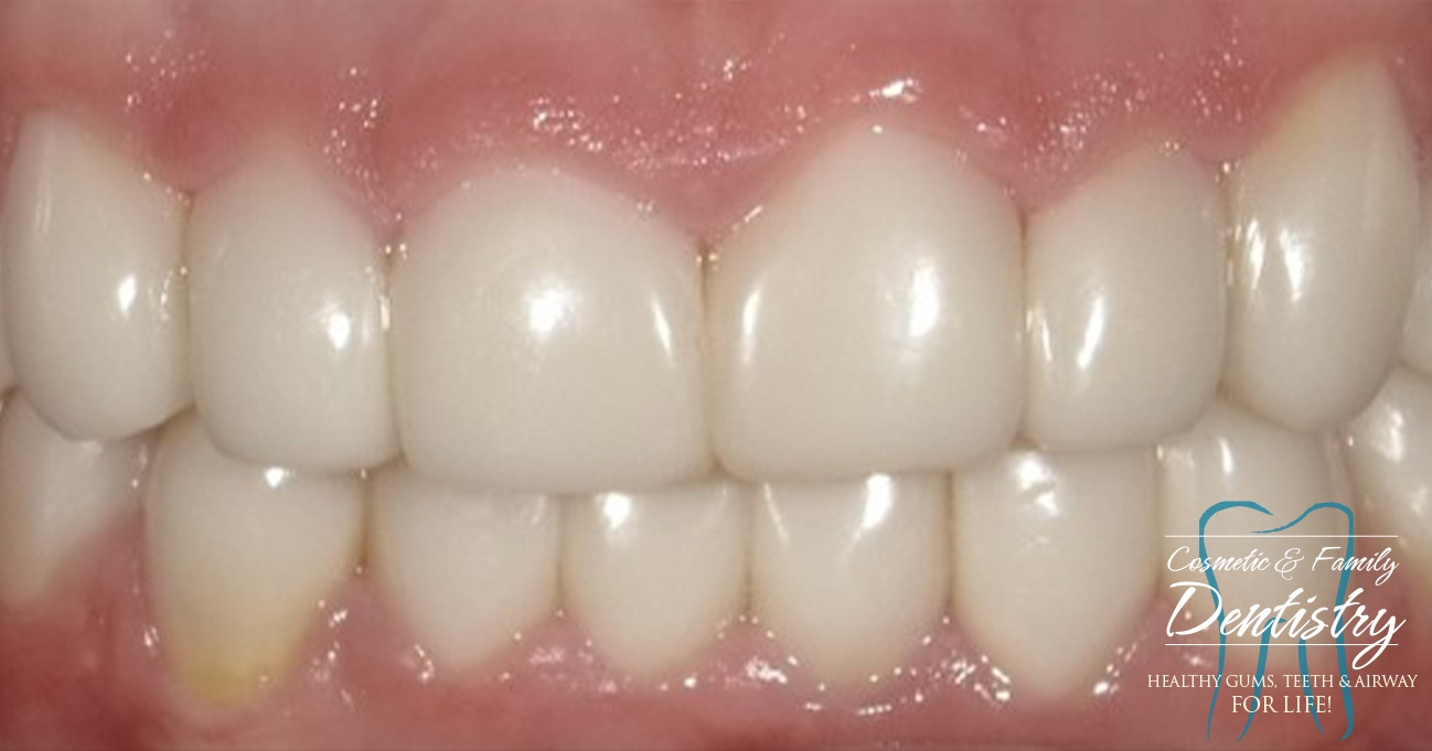 Close up of flawless smile after Bioclear dental bonding