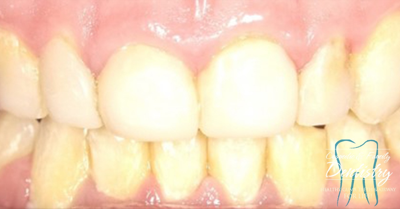 Close up of imperfect teeth before Bioclear dental bonding