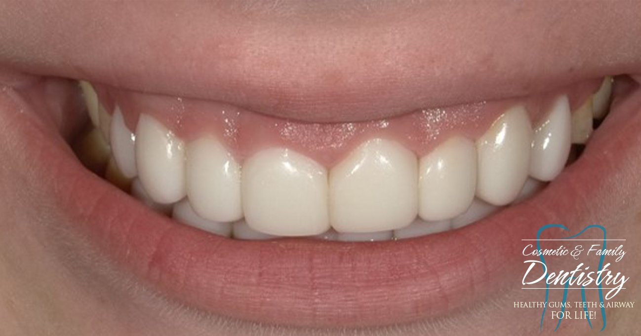 Close up of flawless smile after Bioclear dental bonding