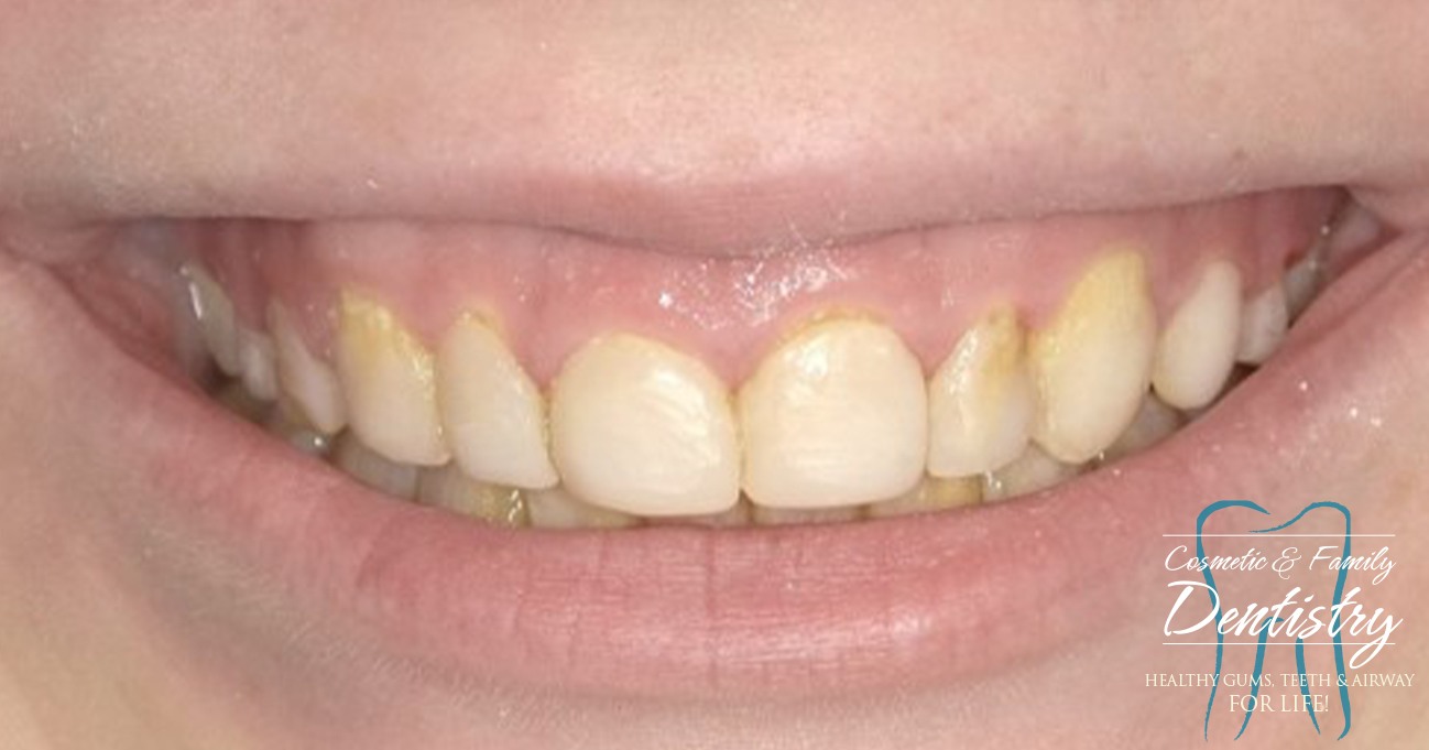 Close up of imperfect teeth before Bioclear dental bonding