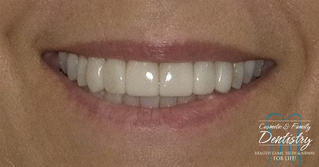 Close up of flawless smile after Bioclear dental bonding