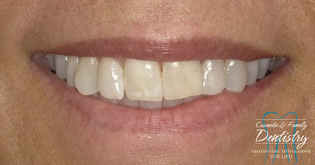 Close up of imperfect teeth before Bioclear dental bonding