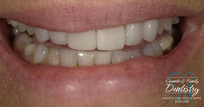 Close up of flawless smile after Bioclear dental bonding