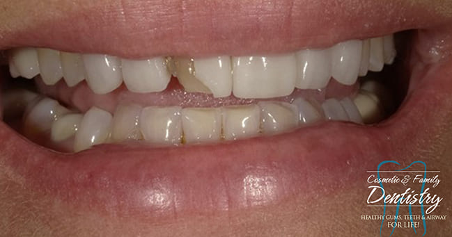 Close up of imperfect teeth before Bioclear dental bonding