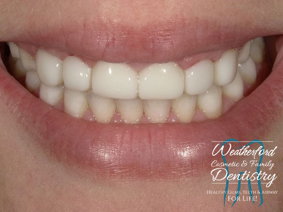 Close up of flawless smile after Bioclear dental bonding