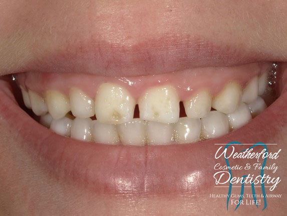 Close up of imperfect teeth before Bioclear dental bonding