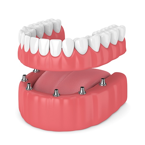 Illustration of implant dentures in Weatherford, TX