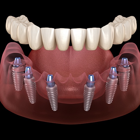 Illustration of dentures being attached to dental implants