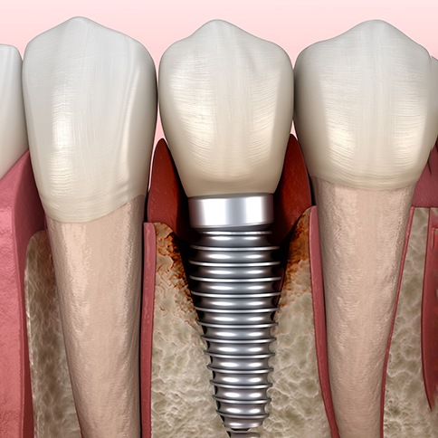 Illustration of how peri-implantitis affects the jawbone